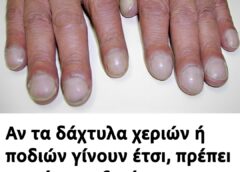 Αν τα δάχτυλα χεριών ή ποδιών γίνουν έτσı, πρέπεı να κάνετε εξετάσεις στους πνεύμονες