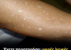 Γιατί εμφανίζονται μικρές λευκές κηλίδες στο δέρμα σας