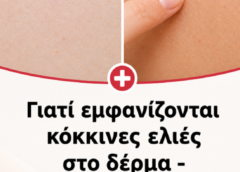 Γιατί εμφανίζονται κόκκινες ελιές στο δέρμα – Τι λέει η επιστήμη